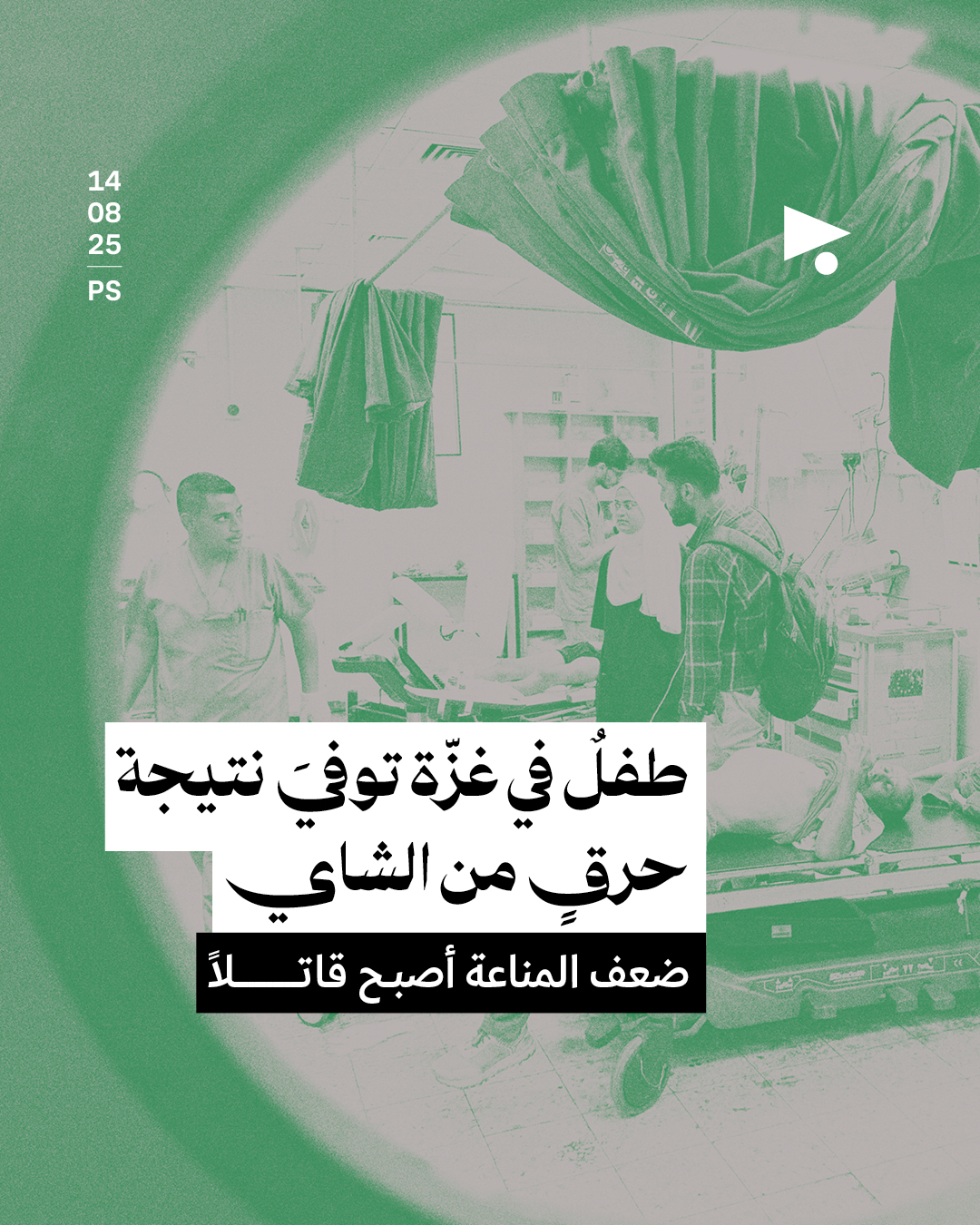 طفلٌ في غزّة توفيَ نتيجة حرقٍ من الشاي